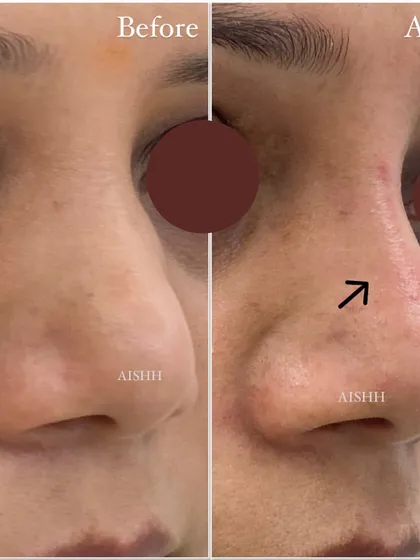 Another angle showing the results of the non-surgical nose job. This quick procedure can make a significant difference in facial harmony and profile balancing.