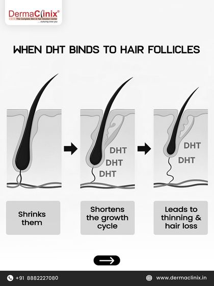 This diagram shows exactly how DHT affects your hair. It binds to follicles, shrinking them and shortening the growth cycle, which ultimately leads to thinning and hair loss.