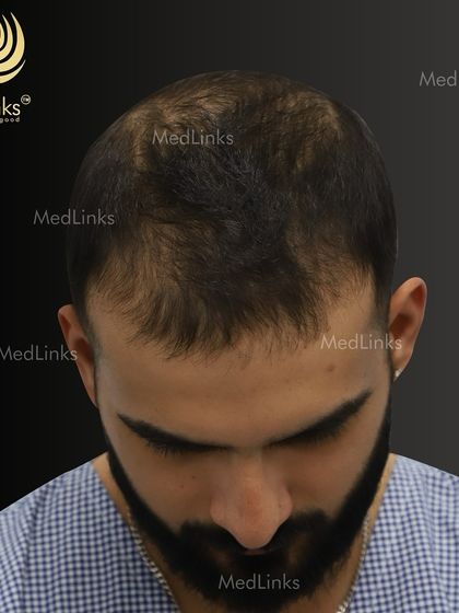 A top-down look at the patient's hair before treatment, showing the thinning pattern on his scalp. This is the starting point from which we build a new story of confidence.