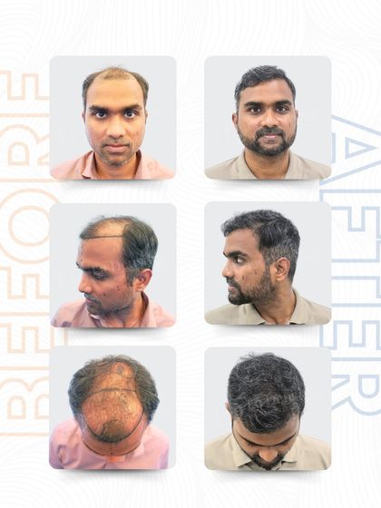 Here are the complete results of Mr. Koushik Verma’s 5,237-graft hair transplant. You can see the significant improvement in density and the natural flow of the hairline from all angles, showcasing a truly comprehensive restoration.
