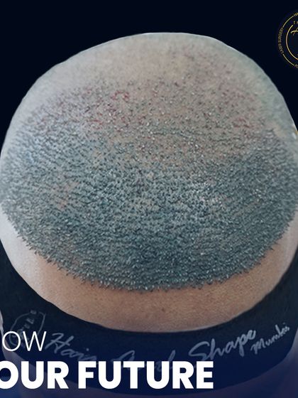 Here you can see the transplanted area from the back. The headband is used for comfort post-procedure. Our FUE technique ensures that the results are not just effective but the process is also designed for patient comfort.