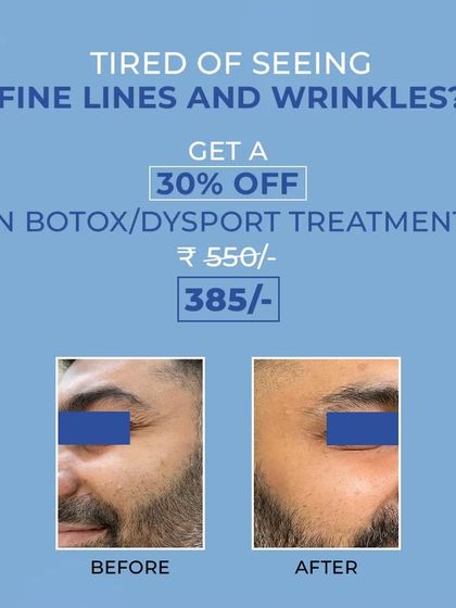 This before and after shows the power of Botox and Dysport in smoothing dynamic wrinkles. By precisely targeting the muscles that cause fine lines, we achieve a significantly smoother and more youthful look around the eyes and forehead.