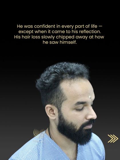 Abhilash before his transplant, feeling unconfident due to his hair loss.