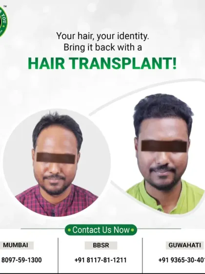 Your hair is your identity. This graphic shows a clear before and after, illustrating how a hair transplant can bring back not just your hair, but a key part of who you are.