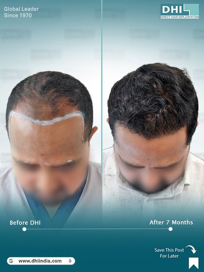 A top-down view of a Norwood Grade III patient, 7 months after receiving 8,432 implanted hairs. The image shows the newly designed hairline and the significant density achieved in the frontal region.