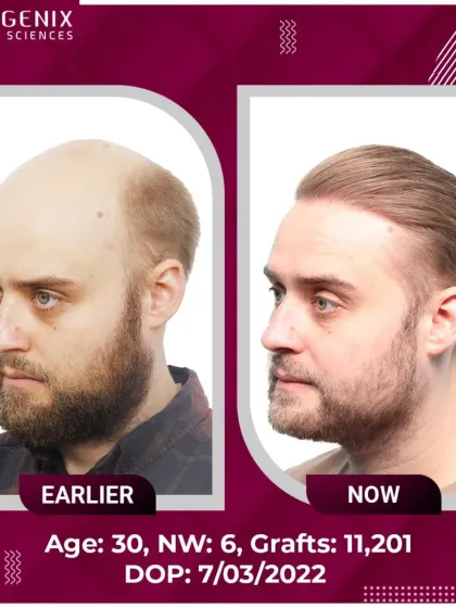 A stunning DHT hair restoration for a 30-year-old with Grade 6 baldness, requiring 11,201 grafts.