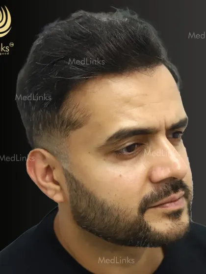 The 'after' side profile, showcasing a well-defined and natural hairline that complements the patient's facial structure.