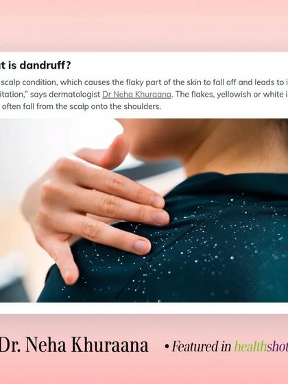 Dandruff is a common scalp condition that causes flaky, irritated skin. In my HealthShots article, I explain the causes and provide natural solutions for relief.