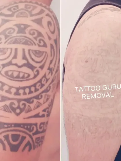 Removing a large, dense tribal tattoo like this one on the shoulder takes time and multiple sessions. This before and after photo shows the significant fading possible, clearing the skin for a fresh start.