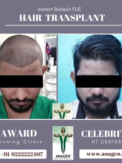 This before and after photo shows a patient's journey from post op to a full head of hair, highlighting the natural looking results of our procedures.