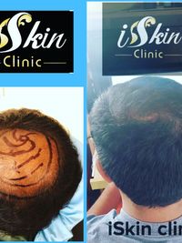 Hair Loss Treatment & Restoration
