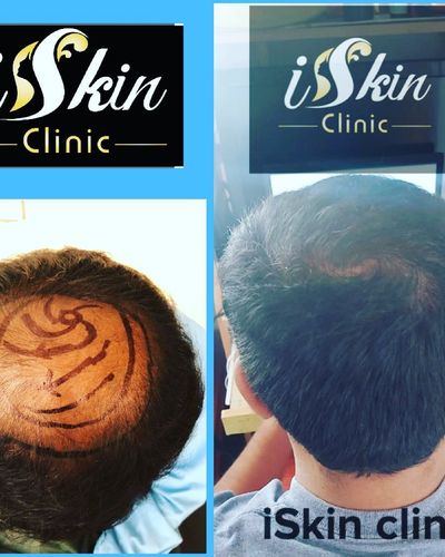 Hair Loss Treatment & Restoration