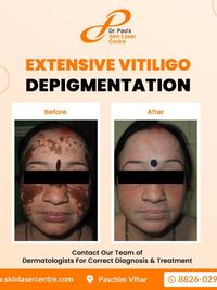 Vitiligo Treatment