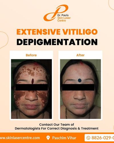 Vitiligo Treatment