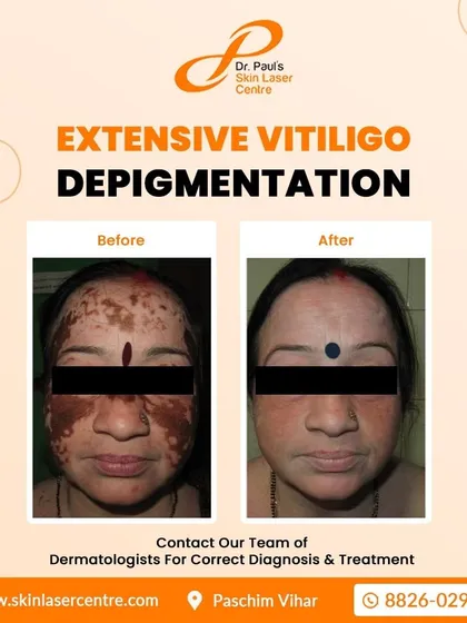 For cases where vitiligo affects a majority of the skin, depigmentation therapy can be an effective option. This treatment helps to even out the overall skin tone by lightening the remaining pigmented skin, as you can see in this patient's successful transformation.