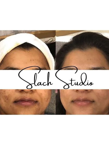 A before-and-after showing the reduction of spots and an overall brightening of the skin tone.