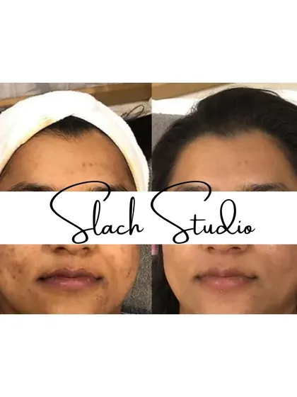 A before-and-after showing the reduction of spots and an overall brightening of the skin tone.