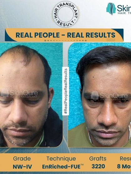 A frontal before and after view of a corrective hair transplant. Notice the natural-looking hairline and improved density. Our goal is to create results that not only look good but also restore the patient's confidence.