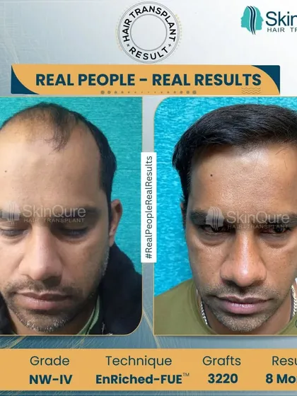 A frontal view of the 33-year-old patient with Norwood Grade 4 hair loss. The 8-month result after 3220 grafts shows a complete restoration of his hairline and a confident new look.