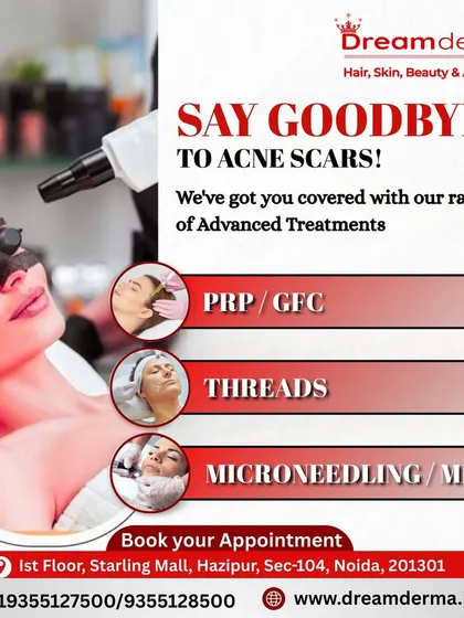 Don't let acne scars define your skin. We offer a powerful combination of treatments like PRP/GFC, Threads, and Microneedling (MNRF) to repair and resurface the skin. This approach effectively reduces the appearance of scars and improves overall skin texture for a clear, confident look.
