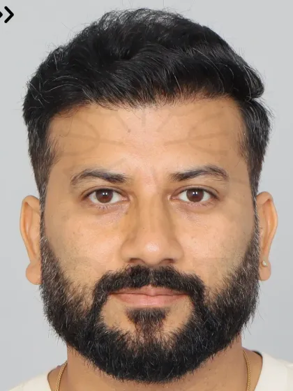 A 9-month result for a Diffuse Grade 6 patient. We used 4500 grafts to restore the hairline, frontal region, mid-scalp, and crown.