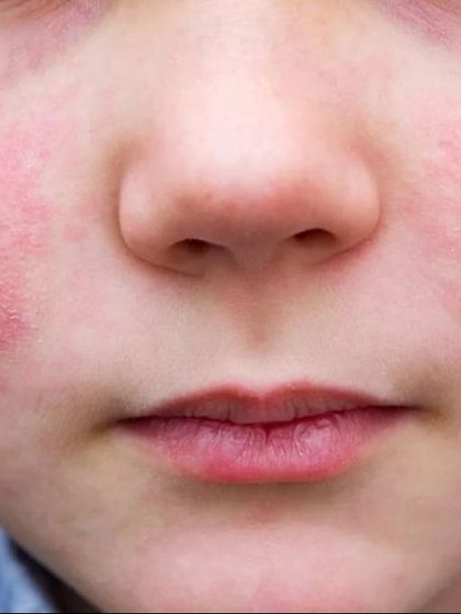 Red cheeks in a child could be a sign of several conditions, from eczema to a simple irritation. I help parents understand the cause and provide a safe treatment plan to calm the skin and restore its healthy balance.