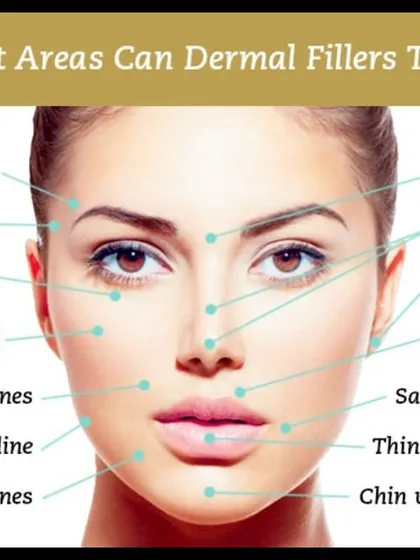 Dermal fillers are an excellent non-surgical option for restoring facial volume and smoothing lines. This graphic highlights the various concerns I can address to give your skin a hydrated, radiant, and more youthful appearance.