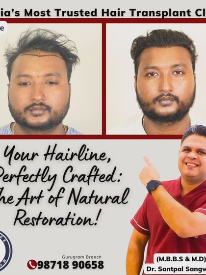 A happy patient with a perfectly crafted hairline. We used 3100 grafts to achieve this dense and natural look in just 8 months. The smile on his face says it all.