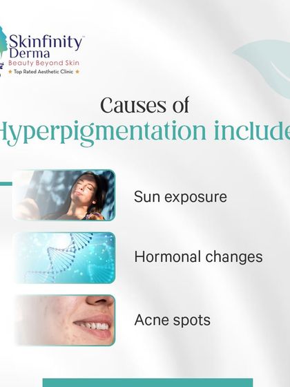 What causes hyperpigmentation? This educational graphic explains the common culprits, including sun exposure, hormonal changes, and acne spots, as part of our deep dive into understanding and treating dark spots.