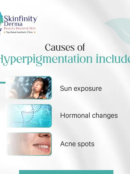 What causes hyperpigmentation? This educational graphic explains the common culprits, including sun exposure, hormonal changes, and acne spots, as part of our deep dive into understanding and treating dark spots.