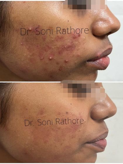 Here you can see the progress in clearing pustular and comedonal acne. The patient was very diligent with her routine, which made all the difference in achieving this result.
