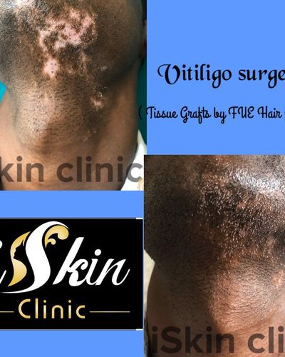 Dermatological Surgery