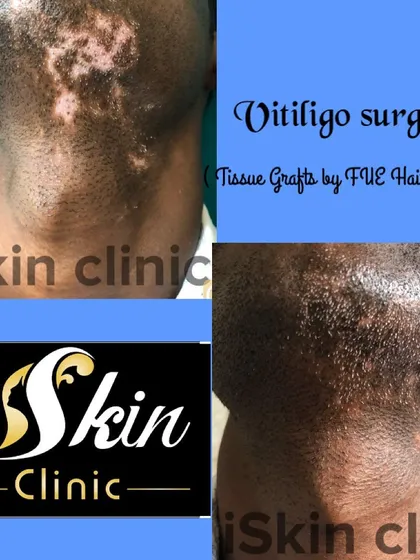 Here we demonstrate the results of a vitiligo surgery on the neck. Using a technique involving tissue grafts from FUE hair follicles, we were able to transplant pigment-producing cells to the depigmented area, achieving significant repigmentation for the patient.