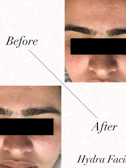 See the visible improvement in skin hydration, brightness, and complexion after just one HydraFacial treatment.