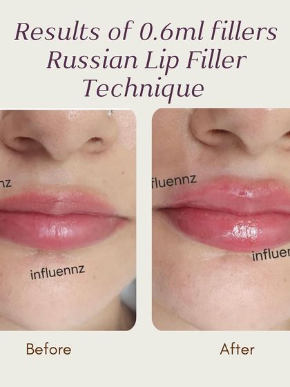 This is a perfect example of the Russian Lip Filler technique using just 0.6ml of filler. It creates a subtle lift and a defined heart-shape without adding excessive volume.