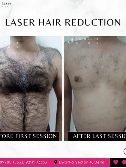 This before and after image shows the significant reduction in chest hair for a male client after completing his sessions. The treatment not only removes unwanted hair but also results in finer, sparser regrowth over time, simplifying your grooming routine for good.