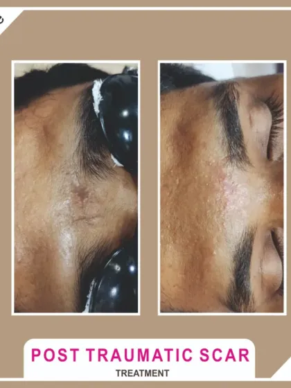 Scars aren't just from acne. This shows a successful non-surgical revision of a post-traumatic scar using advanced laser resurfacing techniques to smooth and blend the tissue.