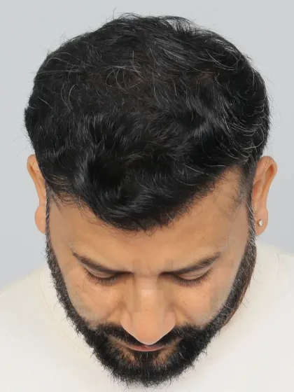A 9-month result for a Diffuse Grade 6 patient. We used 4500 grafts to restore the hairline, frontal region, mid-scalp, and crown.