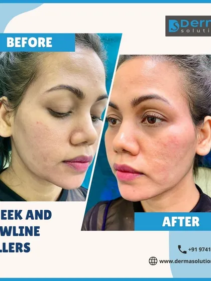 A well-defined facial structure can significantly enhance your profile. This before and after image demonstrates how I use cheek and jawline fillers to add contour and create a more sculpted, youthful look.