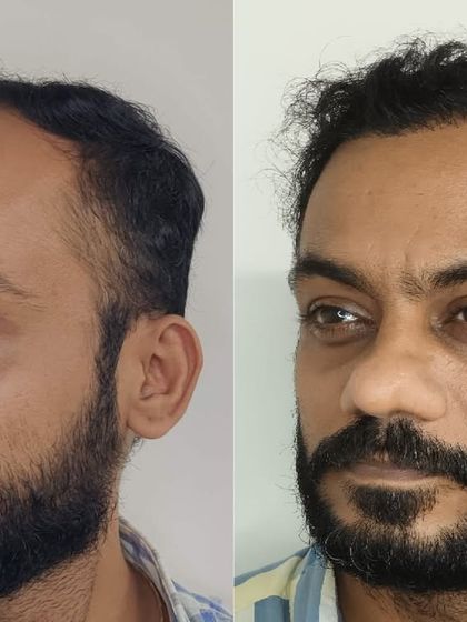 This three-quarter view further showcases the comprehensive coverage and the natural angle of the transplanted hair grafts.