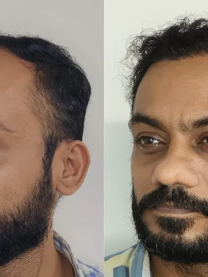 This three-quarter view further showcases the comprehensive coverage and the natural angle of the transplanted hair grafts.