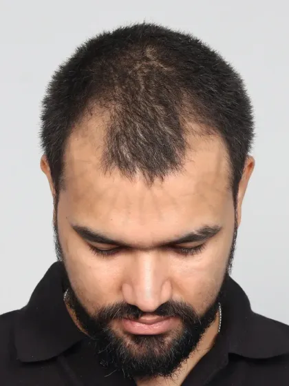 A 10-month natural transformation for a Grade 3 baldness case using 3700 grafts. We recreated the hairline, temples, and frontal zone.