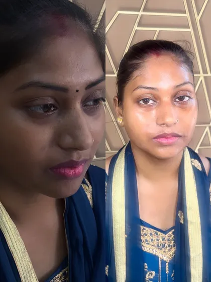 This before and after shows how my Korean treatment effectively tackled hyperpigmentation and dark spots around the eyes and cheeks. The result is clearer, brighter, and more luminous skin.
