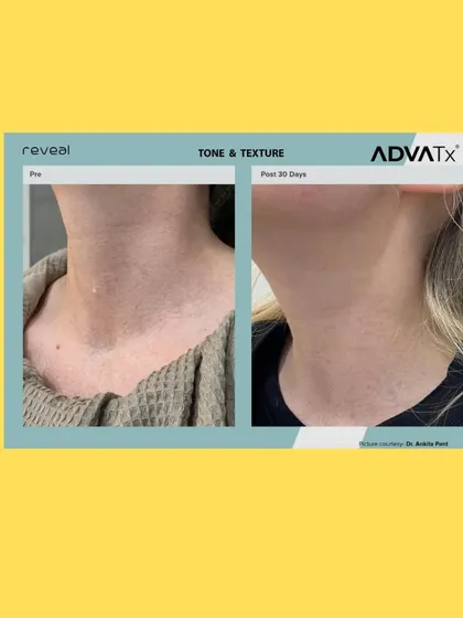 This before and after comparison on the neck shows a significant reduction in lines and improved skin firmness after just 30 days.
