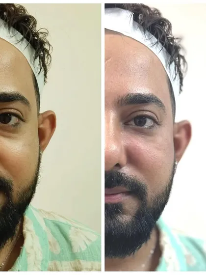 This client's under-eye area was treated for hollowness and fatigue. The after photo shows a plumper, more rejuvenated look, achieved through our personalized treatment plan.