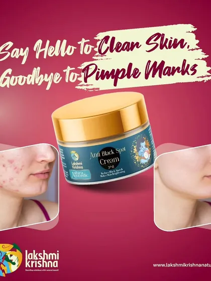 Say hello to clear skin and goodbye to pimple marks with our Anti Black Spot Cream. This before-and-after image shows its effectiveness in brightening and smoothing the skin.