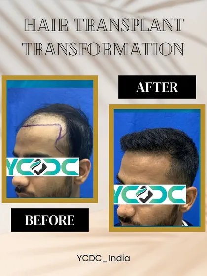 This before and after showcases a natural and dense hairline reconstruction. My goal is always to create results that are indistinguishable from natural hair growth.