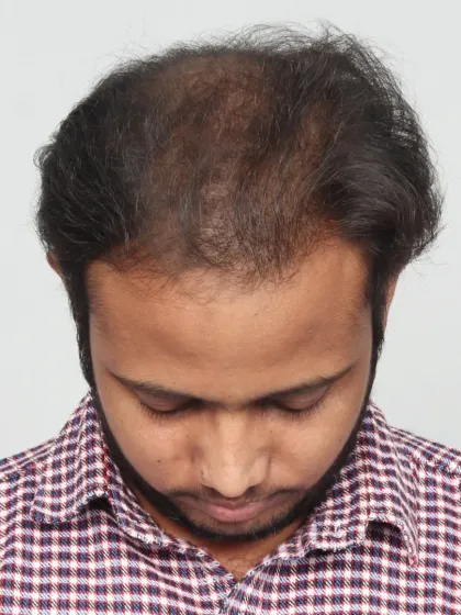 A fantastic 6-month result after implanting 5000 grafts. We recreated the hairline and filled the mid-scalp and crown area.