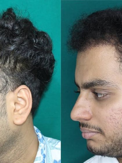 This profile view demonstrates how the new hairline seamlessly connects to the temporal points. This is a key detail for ensuring the hair transplant looks natural from all sides, not just from the front.