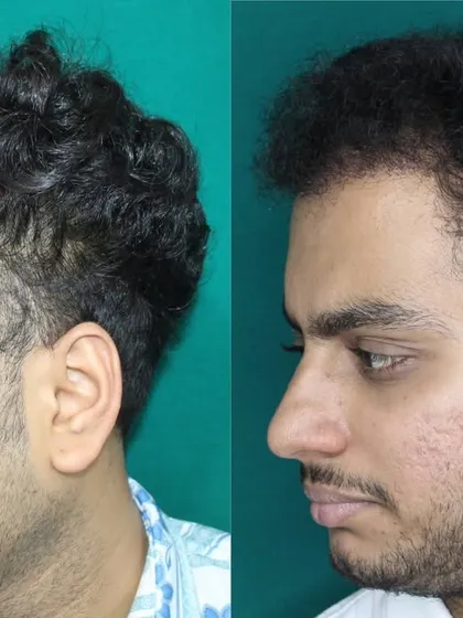 This profile view demonstrates how the new hairline seamlessly connects to the temporal points. This is a key detail for ensuring the hair transplant looks natural from all sides, not just from the front.